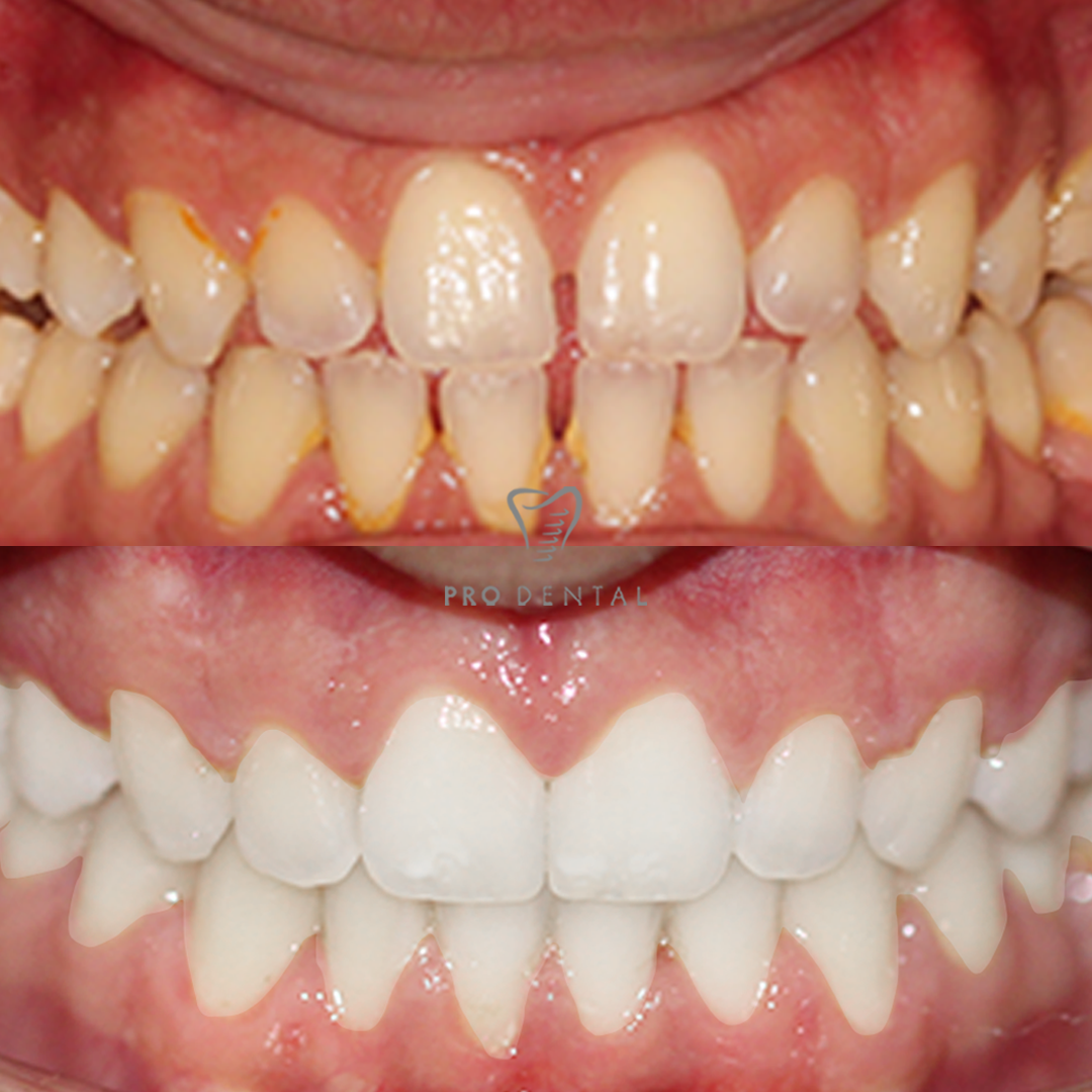 Before and after whitening and alignment — Jeremiah