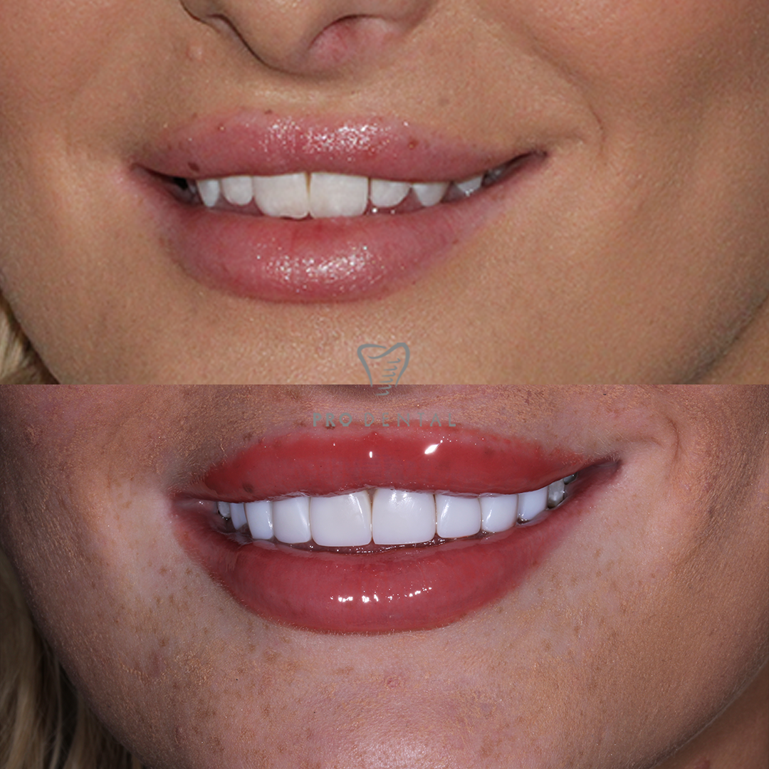 Before and after smile makeover — Amy