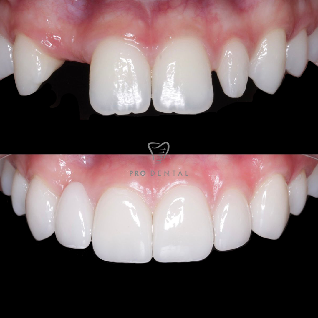 Before and after cosmetic dentistry — Monica