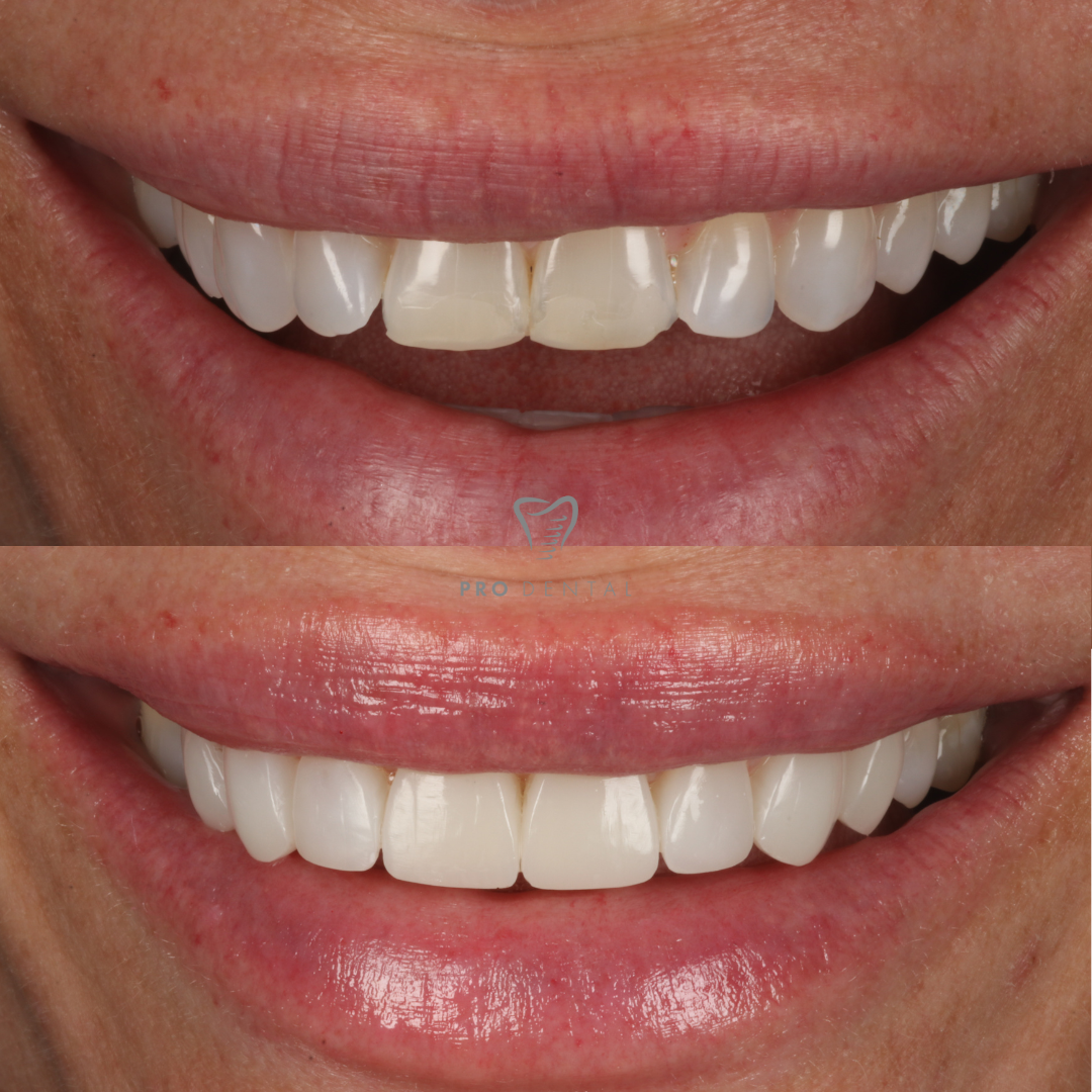 Before and after full upper smile transformation